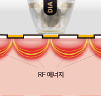 모노 바이폴라 방식